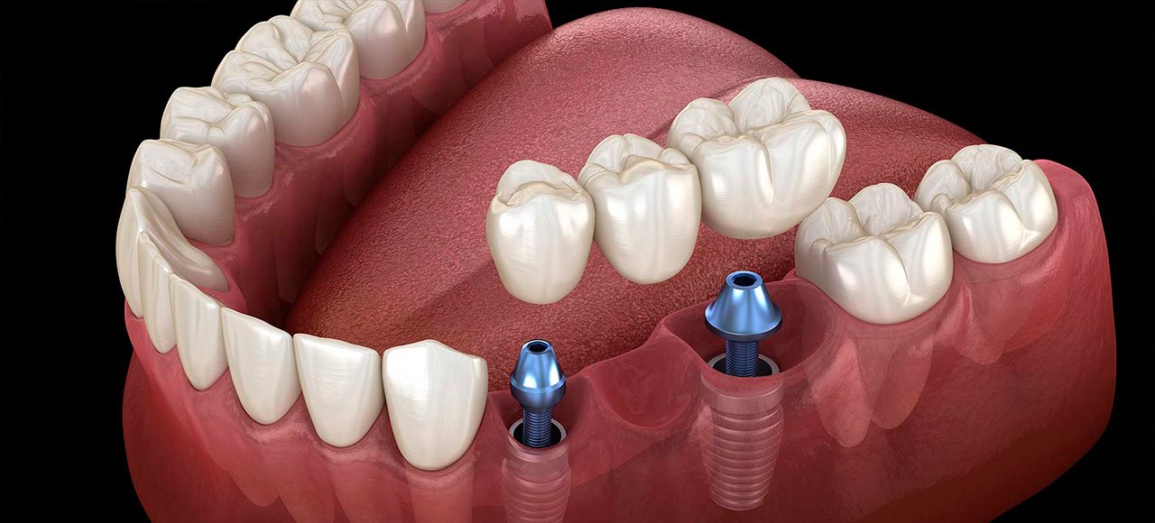 Implante Dentário: Recupere Seu Sorriso com Segurança e Conforto