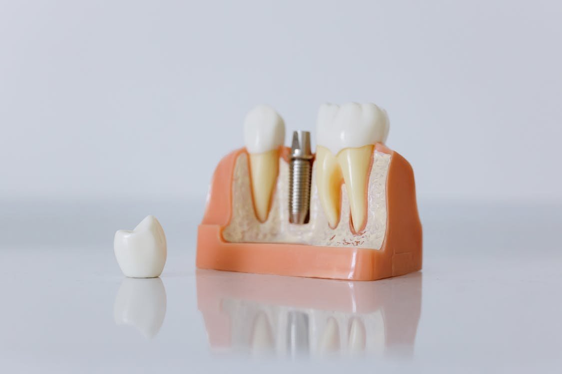 Quais os tipos de prótese dentária móvel? — clínica especializada em implantes e próteses em Curitiba