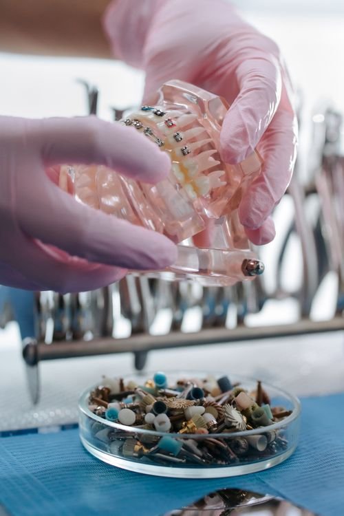 O que substitui um implante dentário — clínica especializada em implantes e próteses em Curitiba