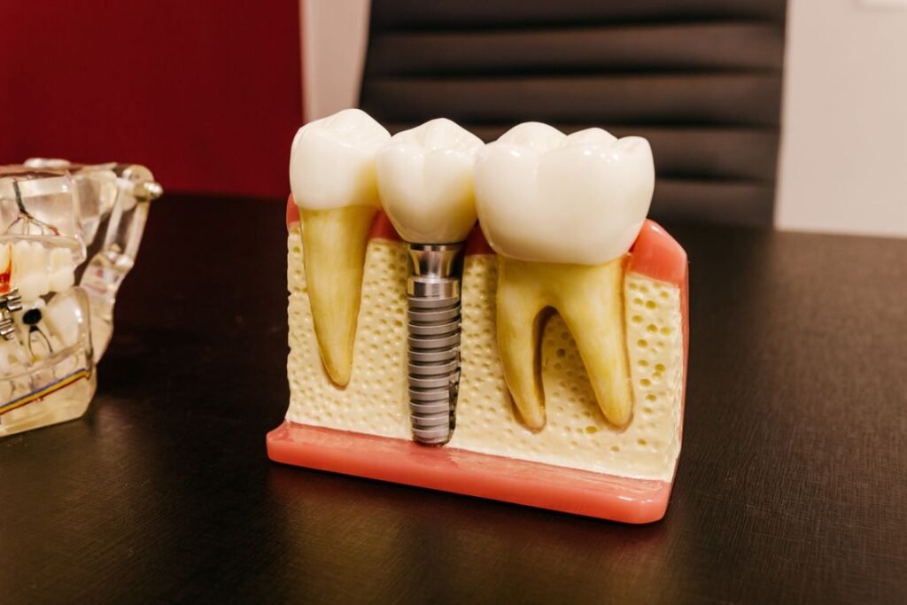 Implante dentário valor 1 dente — clínica especializada em implantes e próteses em Curitiba