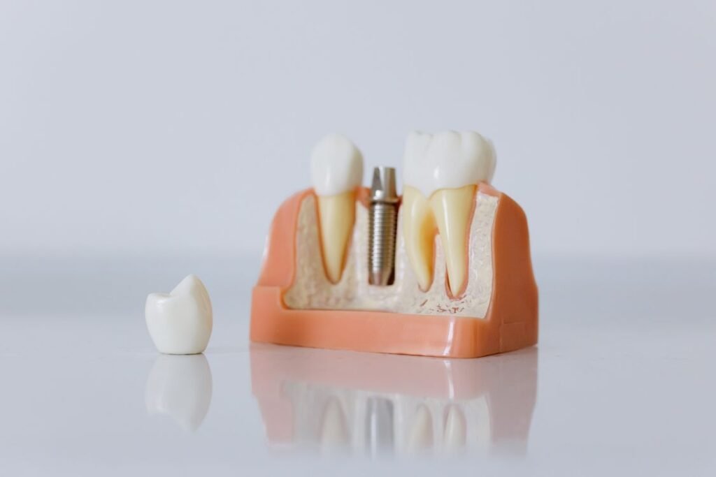 Quanto custa um implante dentário — clínica especializada em implantes e próteses em Curitiba