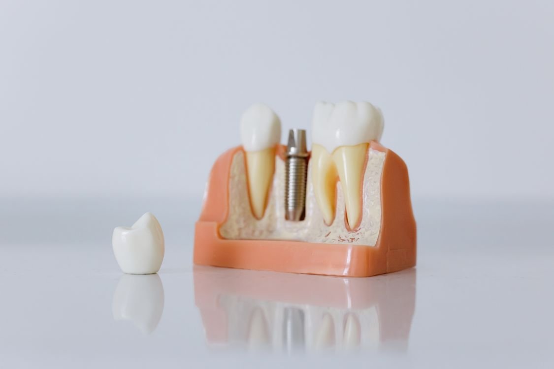 Quanto custa um implante dentário — clínica especializada em implantes e próteses em Curitiba